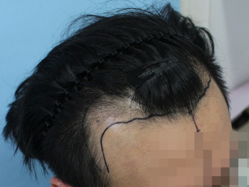 수술전 디자인 (2).jpg
