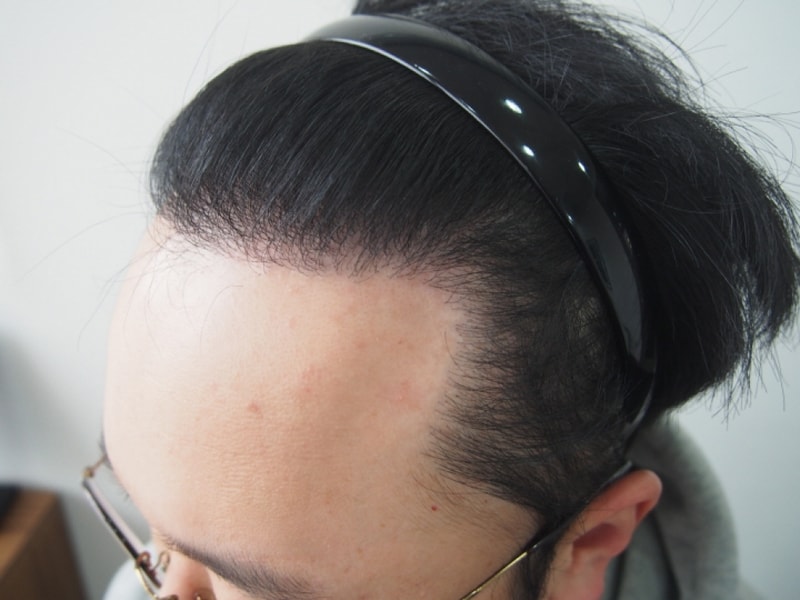 크기변환_수술후 3.JPG