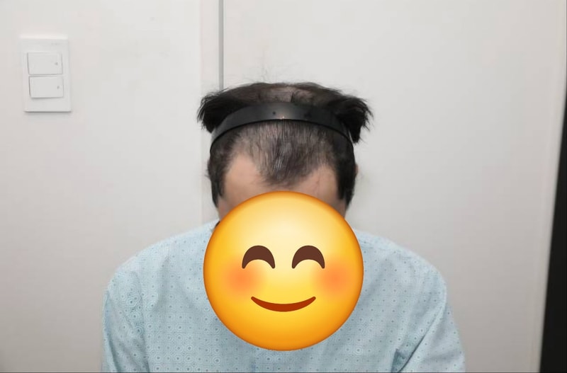 뉴헤어 서울점 절개모발이식 2000모낭 6개월차 후기