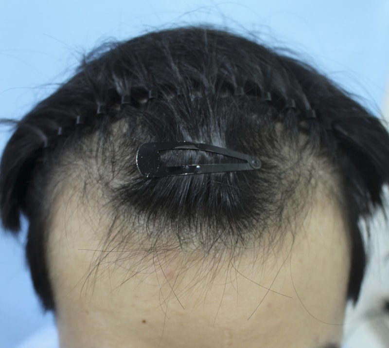 이식 2개월차 됐는데 어떤가요?