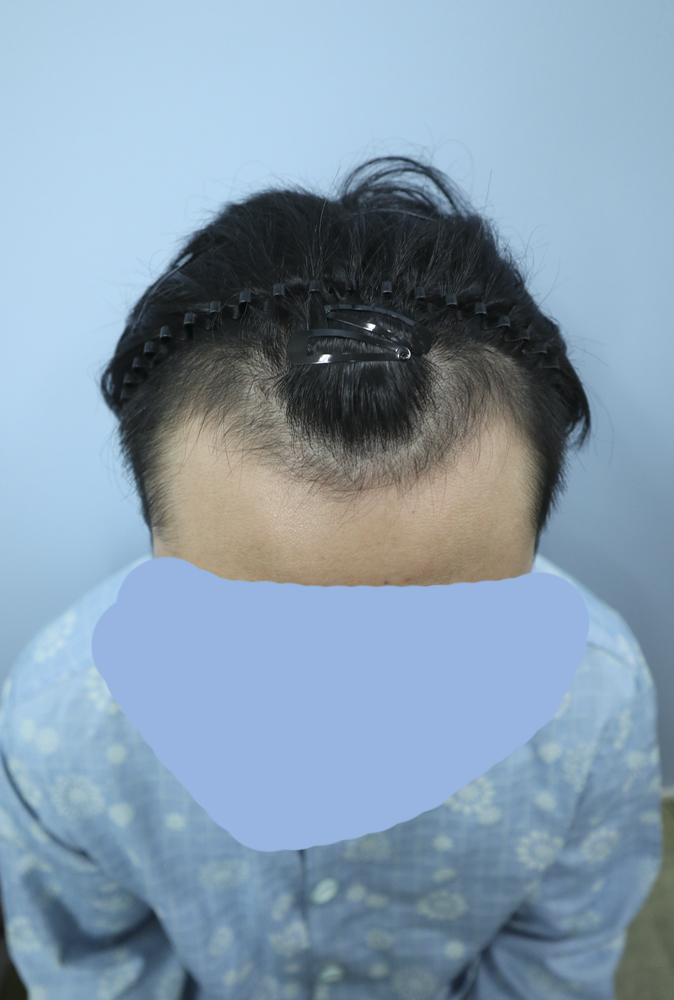 M자 모발이식 수술 받았습니다