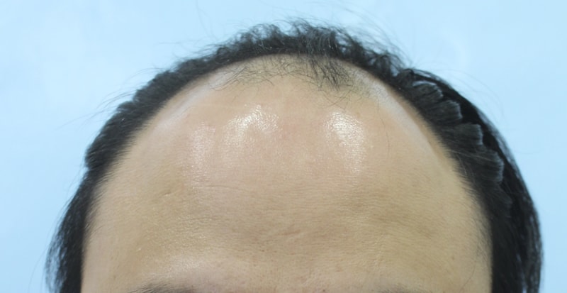 절개 3800모 이식한지 4개월 되었어요