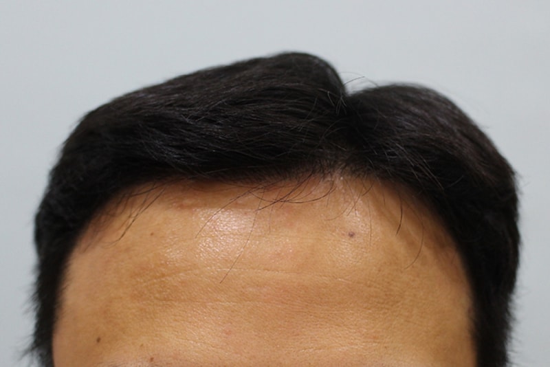 수술후1년 (1).JPG