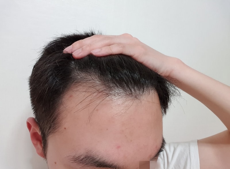 01.최성빈_수술전.jpg