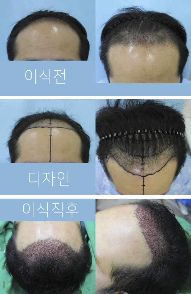 헤어라인 이식 받았어요~ (절개4천모)