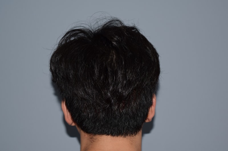 수술직후뒤통수6.JPG