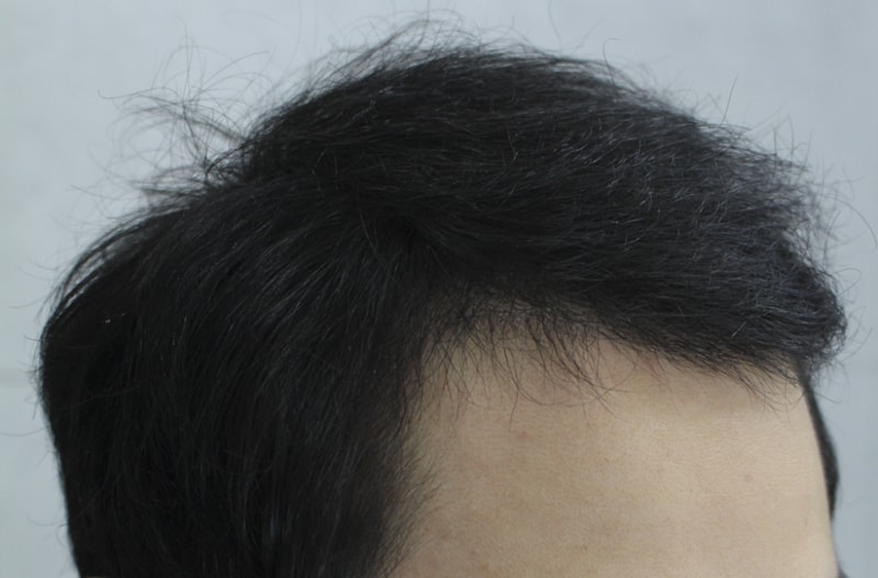 수술후5달 경과 (2).png