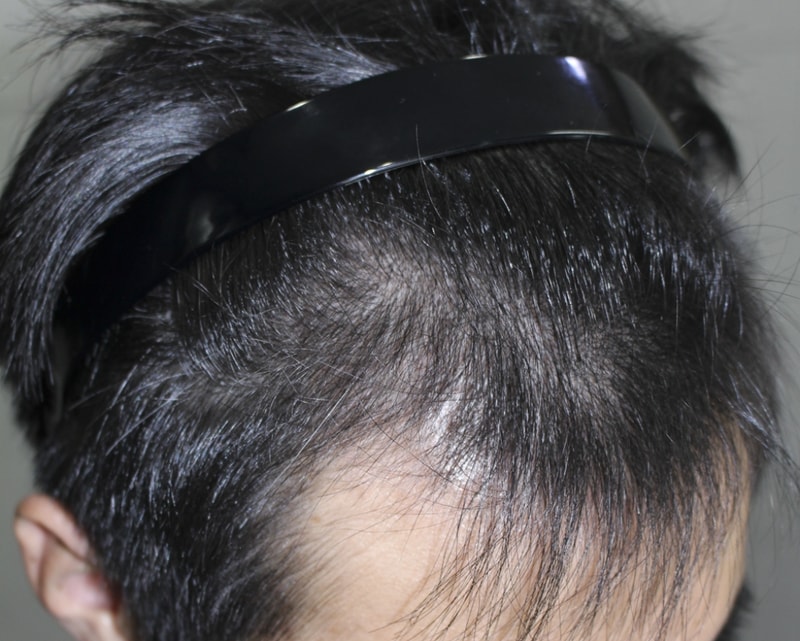 수술후4달경과 (6).png