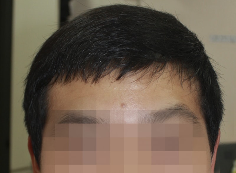 모발이식후_02.png