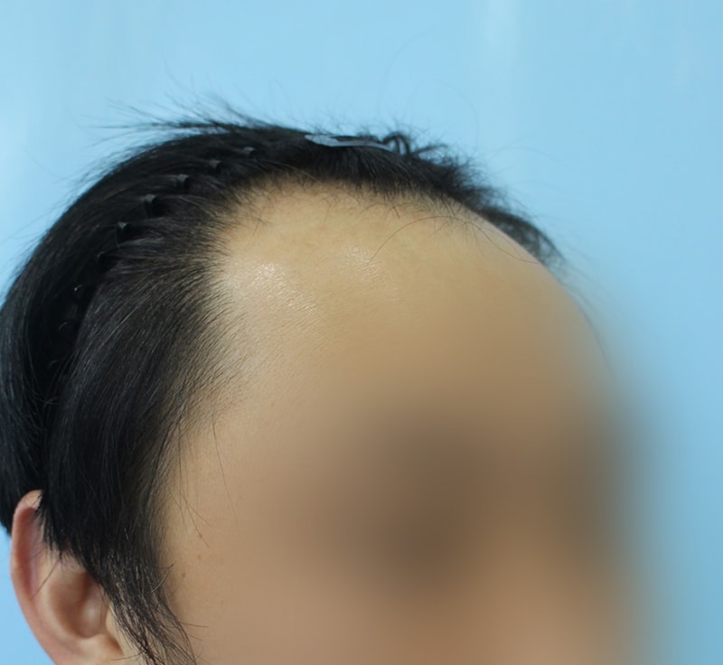 정 성대_20160525_모발_25929.png