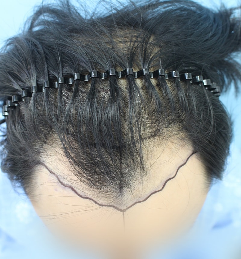 정 성대_20160525_모발_25961.png