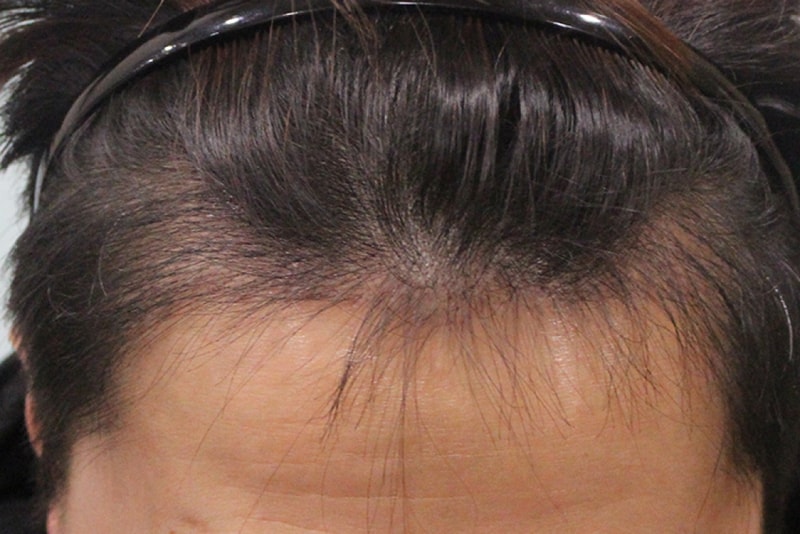 수술후 3개월 (5).JPG