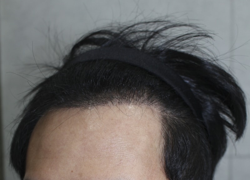 이식후 (3).png