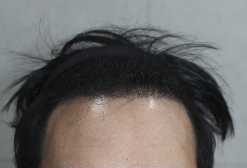 이식후 (1).png
