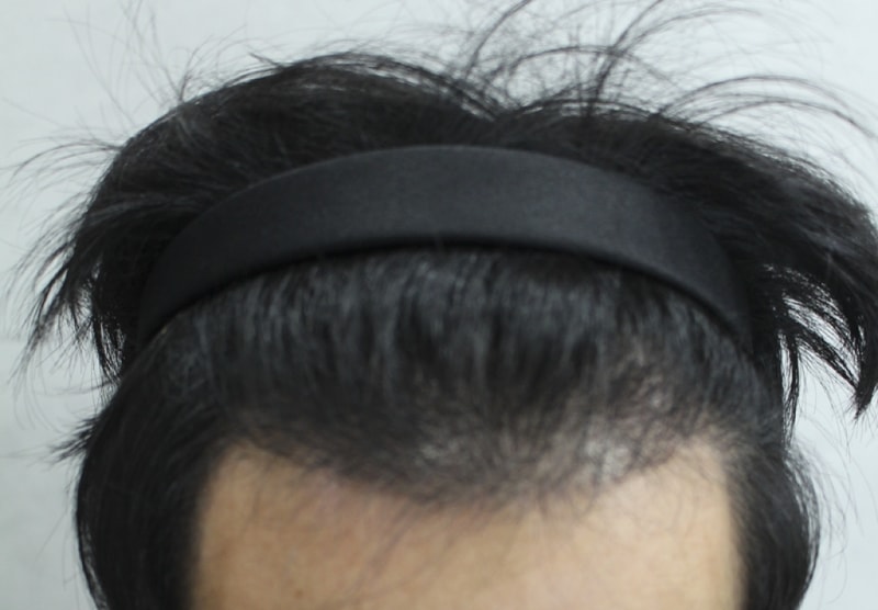 이식후 (4).png