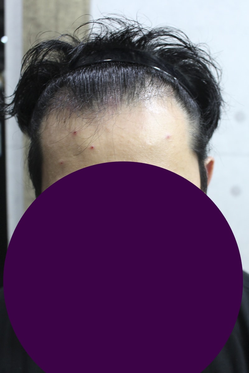 절개 4000모 M+O 이식 암흑기 끝난거 같습니다