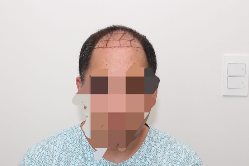 뉴헤어 서울점 비절개 5000모 비절개 모발이식 후기입니다