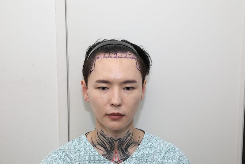 뉴헤어 서울점 절개 모발이식 2000모낭 12개월차 후기