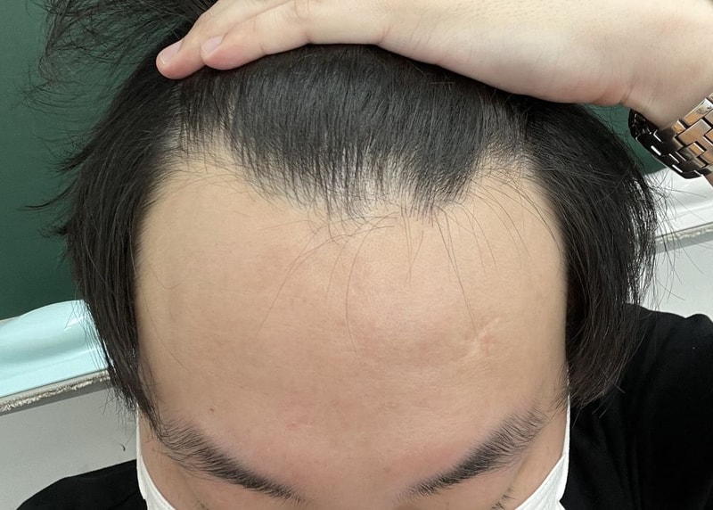 포헤어, 20대 마지막 내게주는 선물 M자이식 후기