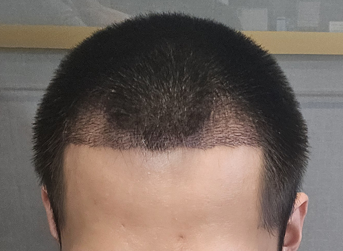 4. 수술2주.jpg