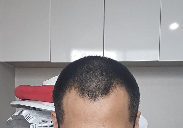 1. 수술전.jpg