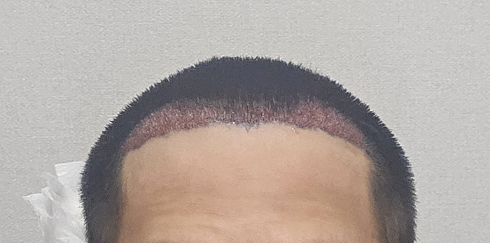 4. 수술직후.jpg