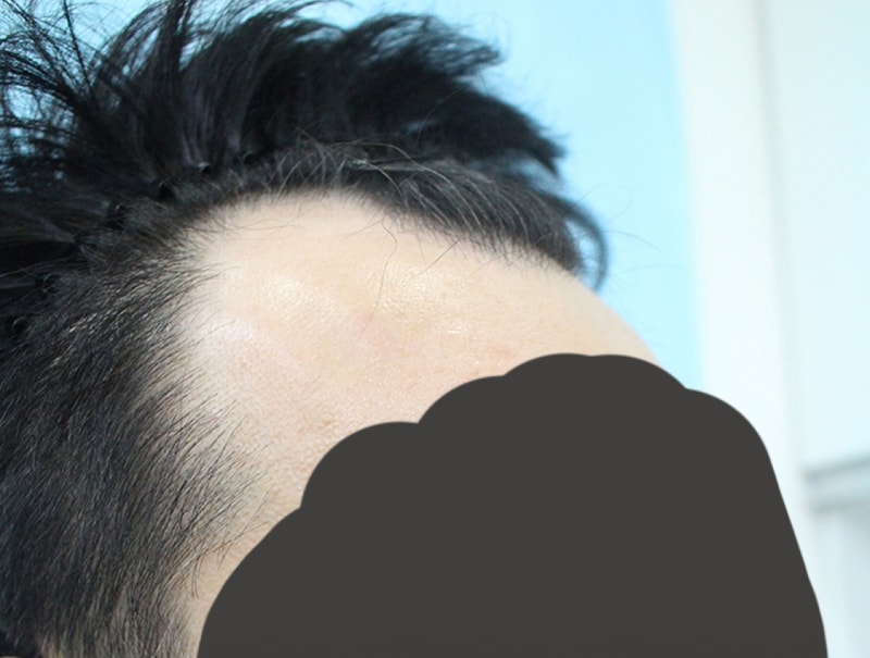절개3800모로 M자 채웠어요~~