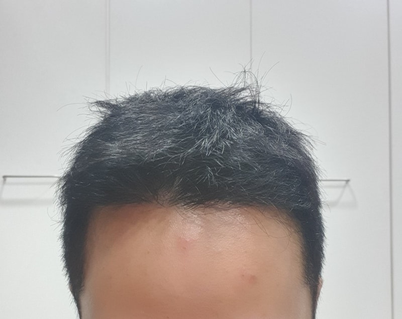 다나 M자 이식 18개월 후기