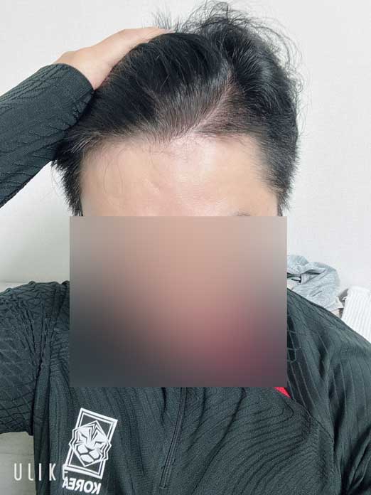 무삭발모발이식 다나성형외과 23개월/장기 후기글/뒤통수상태