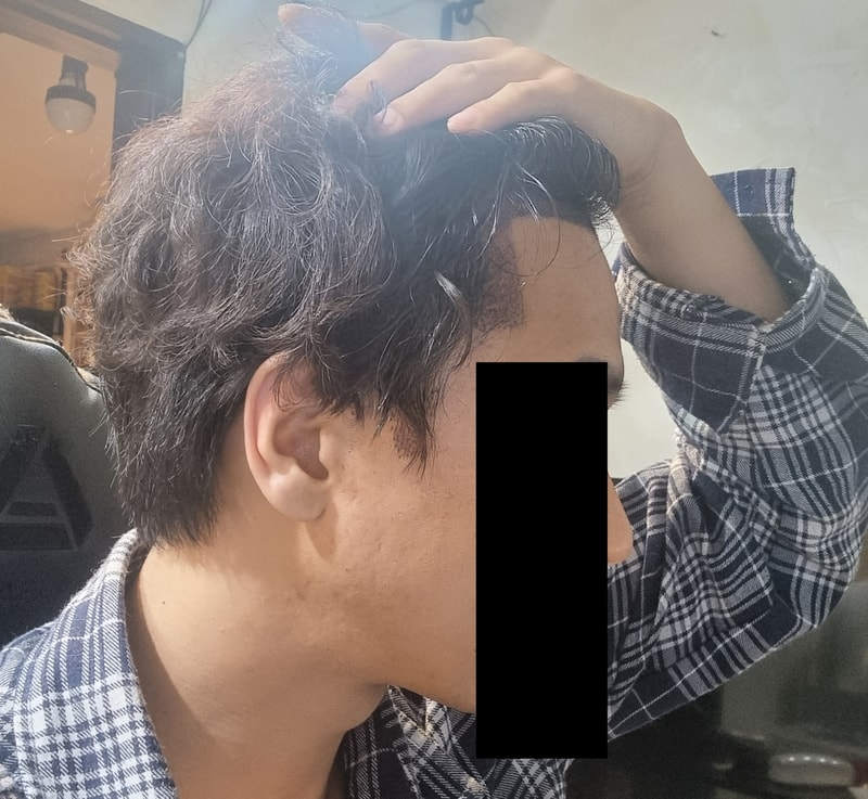 이식 바로후2.png