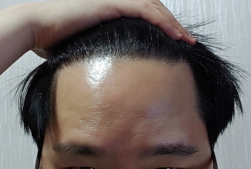 모재성 비절개 8개월 평가 입니다.