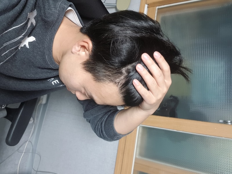 모발이식 14개월차