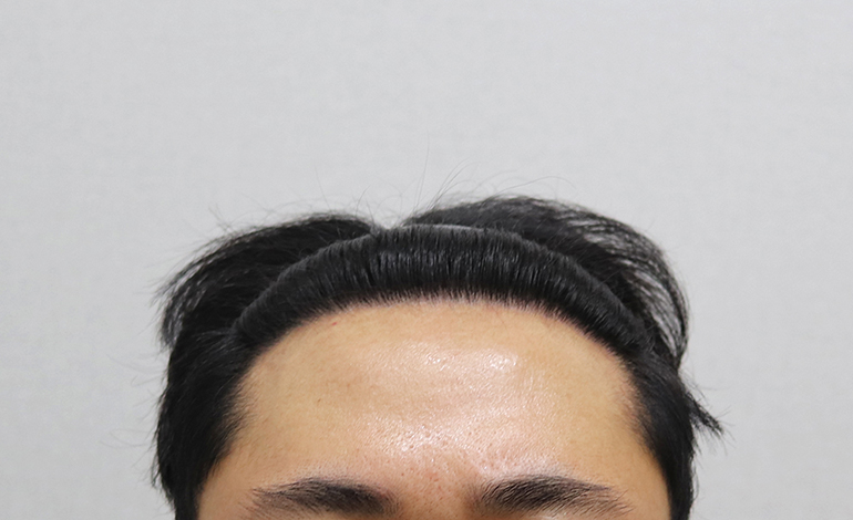 이식 후 정면.JPG