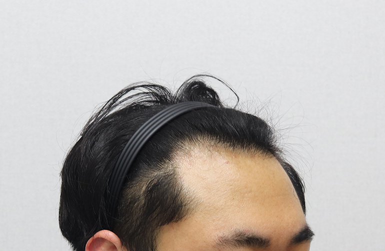 이식 전 오른쪽.JPG
