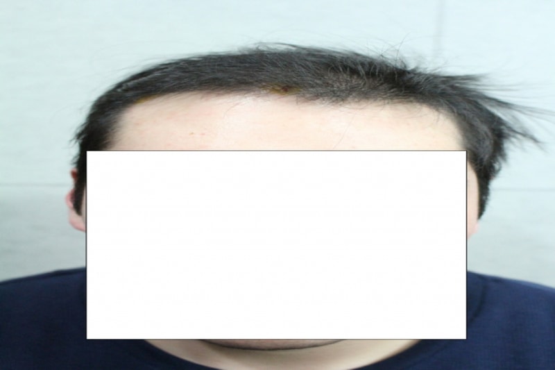 일괄편집_6개월 경과 3.JPG