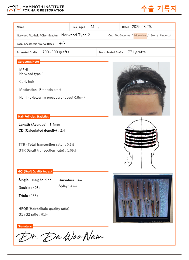 It is a review of hair transplantation with fine hair maintenance non-cut slit. I got the surgery from Nam Da-woo.