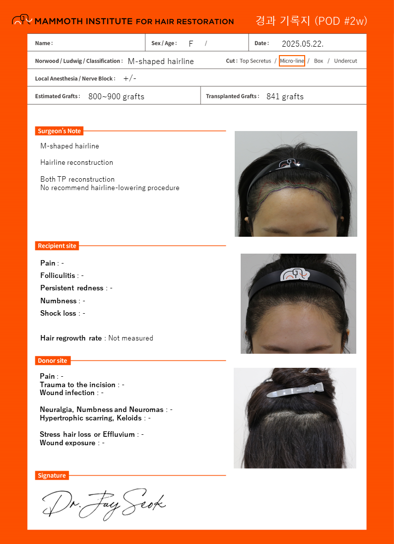 Retention of all baby hairs Slit hairline hair transplant progress