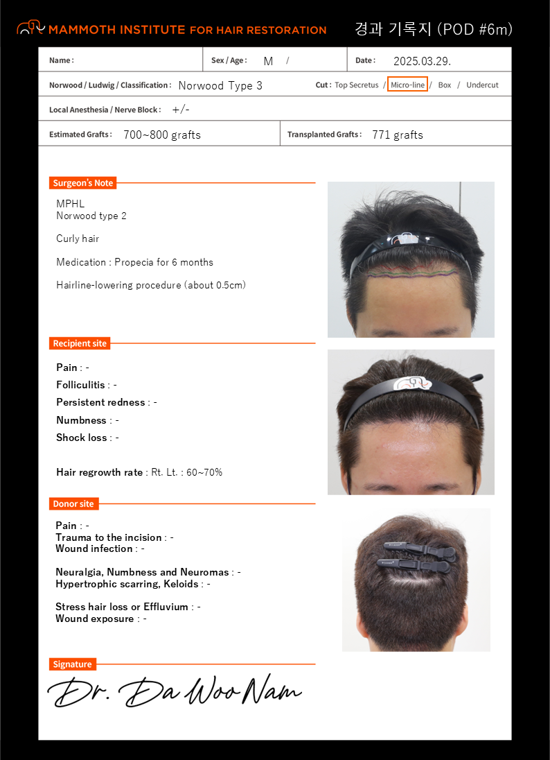 Apgujeong Mammoth Hair Restoration Center Hair Transplant 6 months. Late review. Thank you, Nam Dowoo.