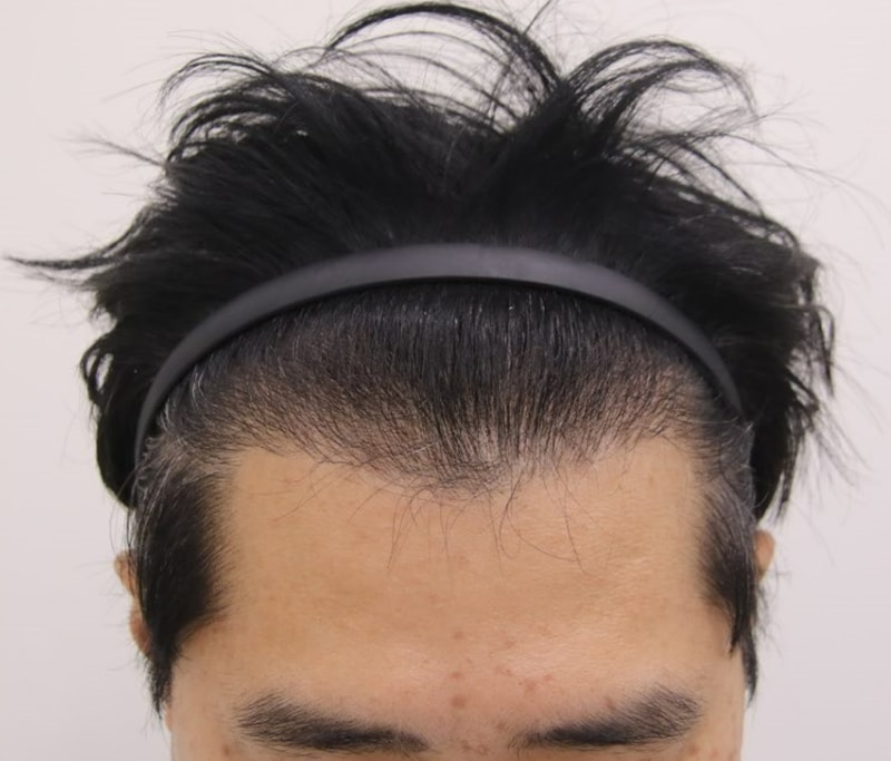 1차수술 실패후 맘모스에서 재수술. 성공