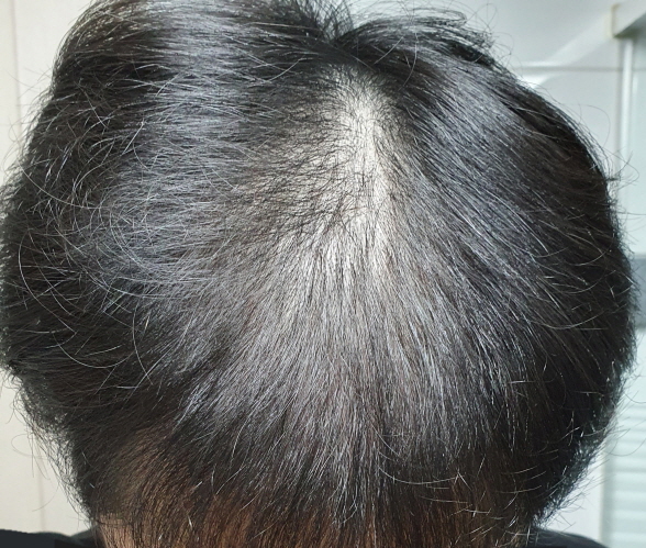 모아트 정수리 및 전두부 10개월차 경과입니다