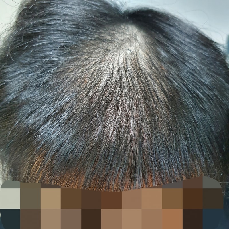 모아트에서 전두부 및 정수리 씨앗 심고 왔습니다