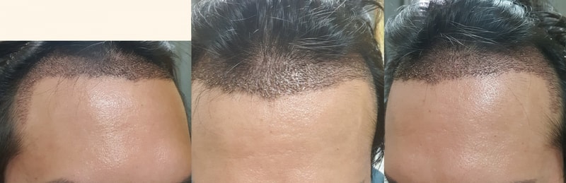 비절개 2100모낭 5개월 후기입니다.