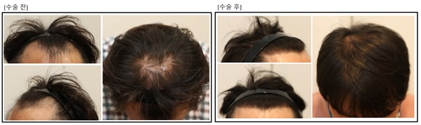모발이식사진.jpg