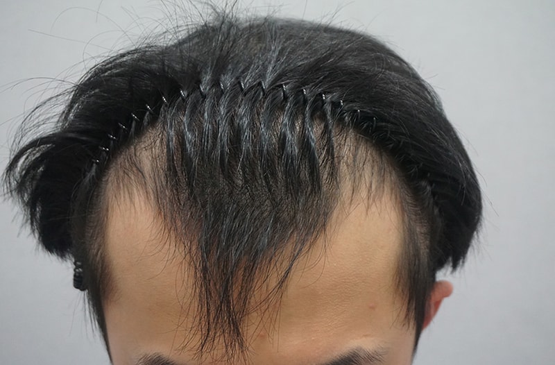 수술전 정면.jpg