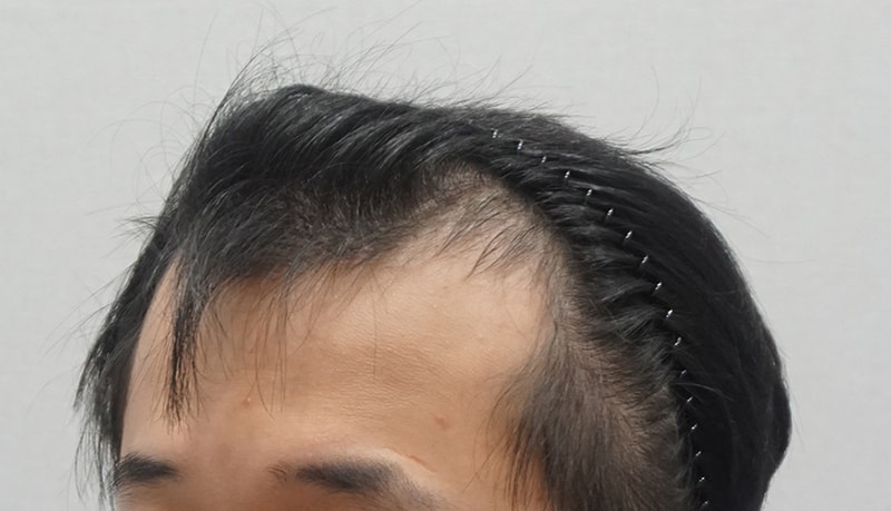 수술전 측면.jpg