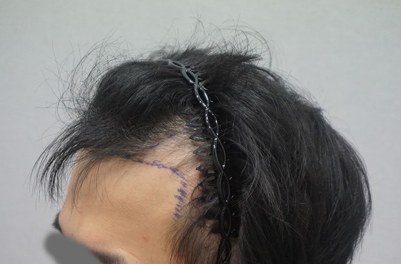 수술전측면 디자인.jpg