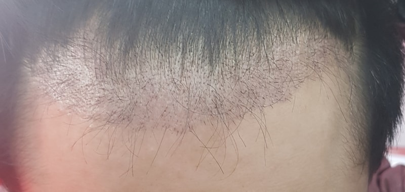 수술 후 50일 되었는데 머리 상태가..