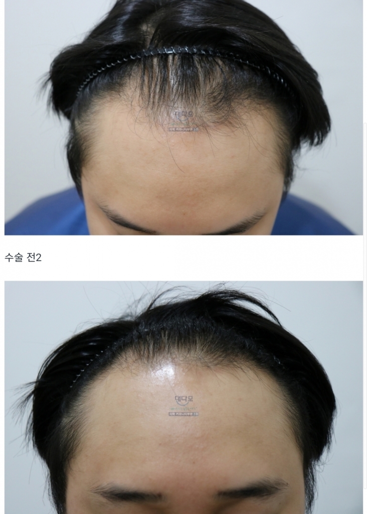 모스트 비절개 3000모 6개월 후기입니다.