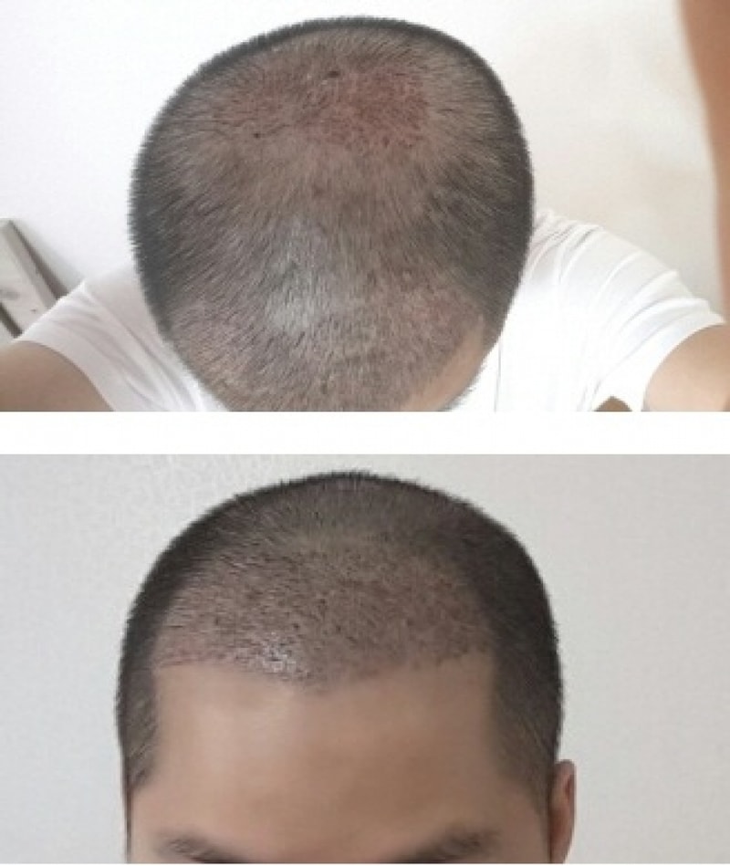 모션 2600모낭 앞머리 밀도 정수리 이식 4주 후기