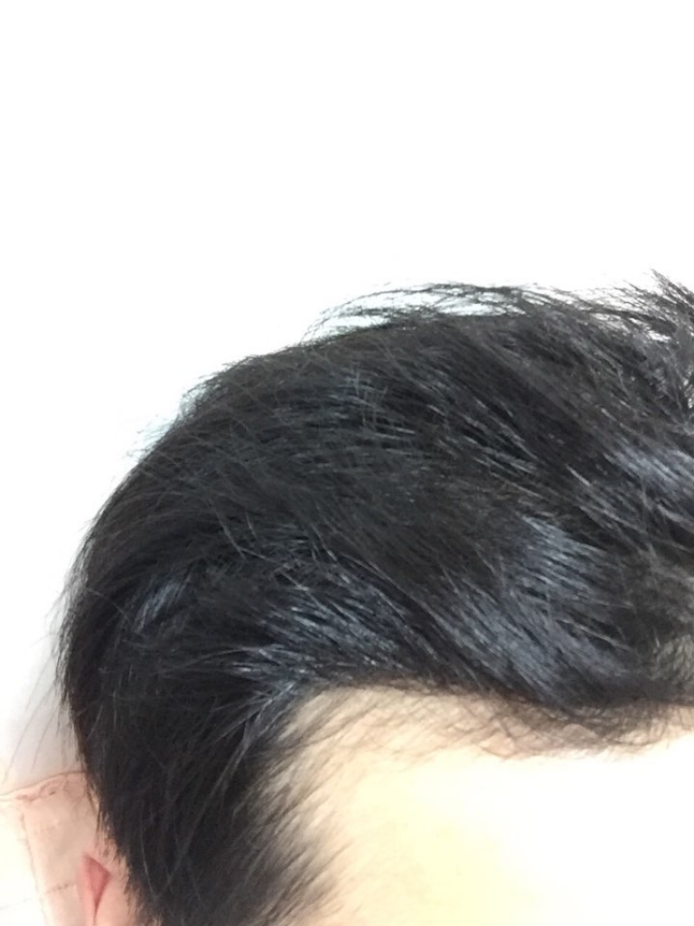 모션!!! 127일 비절개 부삭발 800모낭  경과